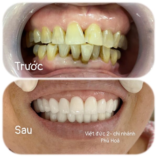 Răng sứ toàn sứ VITA PLUS tại Việt Đức - Tâm Phúc