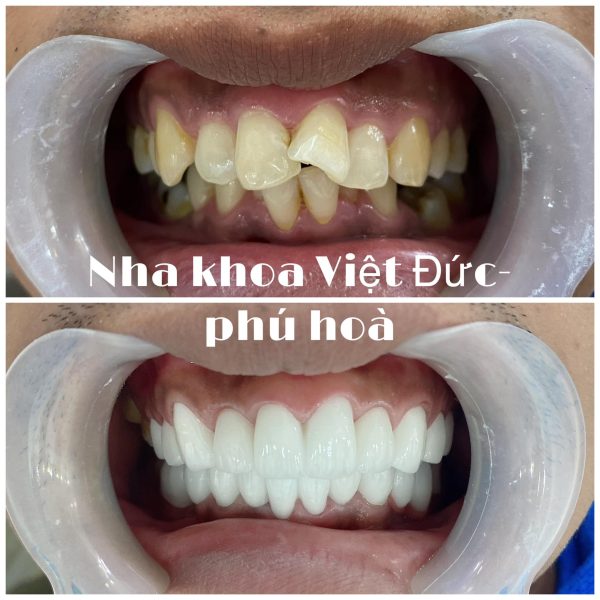 Răng sứ titan tại Việt Đức - Tâm Phúc